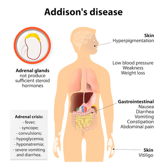 Addison’s Disease: Treatment and Management