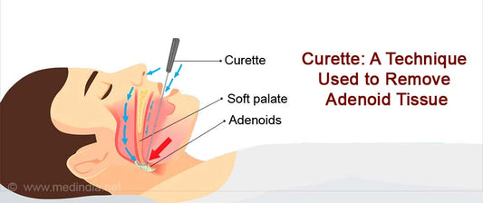 Adenoidectomy Surgical Procedure