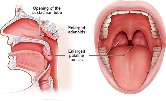 Tonsils and Adenoids